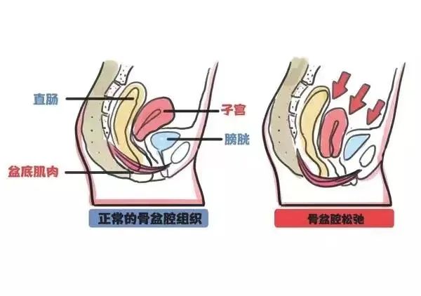 盆底功能障碍性疾病(pelvic floor dysfunction,pfd) 的发生多与盆底